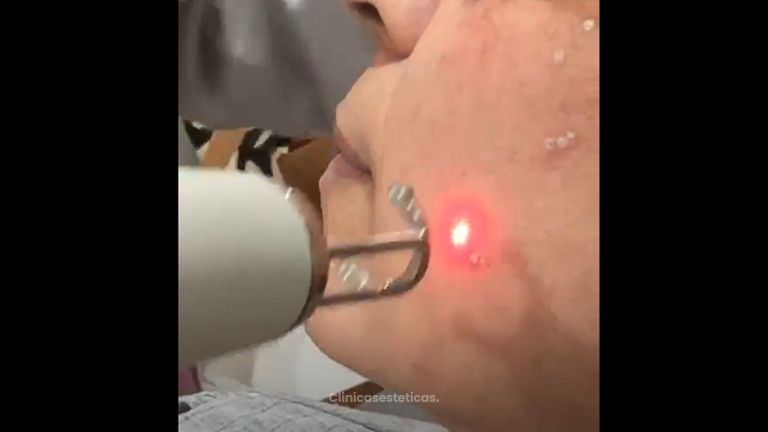 Rejuvenecimiento facial - Clínica Orión