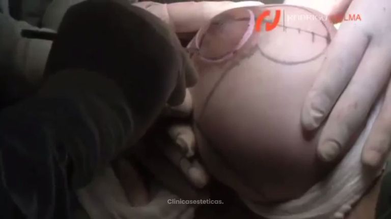 Pon fin a un pecho demasiado grande