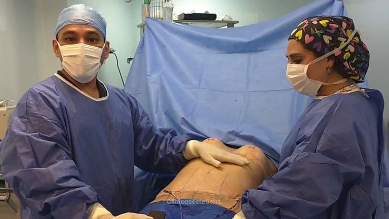 Pexia mamaria y abdominoplastia