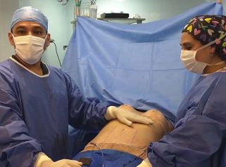 Pexia mamaria y abdominoplastia