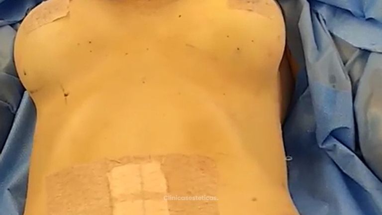 Lipoabdominoplastia