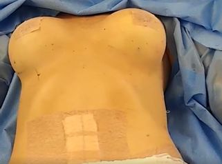 Lipoabdominoplastia