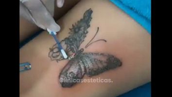 Borrar tatuajes