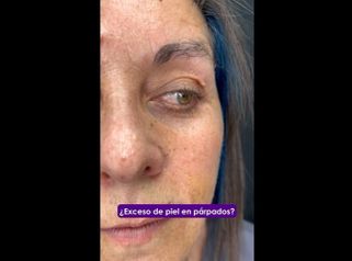 Blefaroplastia - Medicina Estética Integral MD