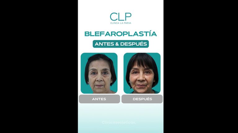 Blefaroplastía - Dr. Pedro Vidal G-H