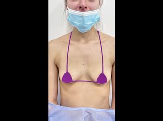 Aumento mamario - Clínica Anastasia