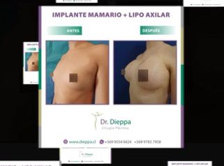 Aumento mamario + Lipo axilar - Cirugía Plástica Dieppa