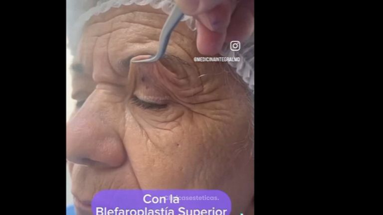 Blefaroplastía Superior - Medicina Estética Integral MD