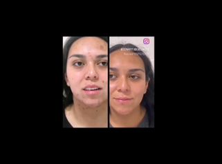 Tratamiento acné - Dermo Studio & Beauty