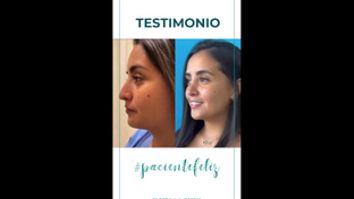 Testimonio Rinoplastia - Dr. Pedro Vidal G-H