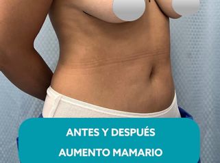 Aumento mamario - Dr. Claudio Silva Vergara