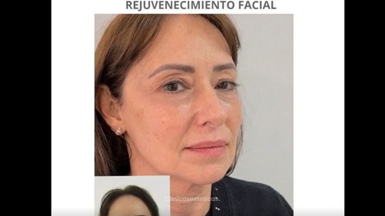 Rejuvenecimiento Facial