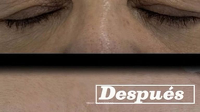 Blefaroplastia sin cirugia - Clínica Visage