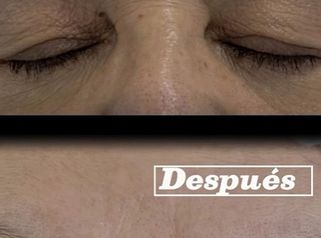 Blefaroplastia sin cirugia - Clínica Visage