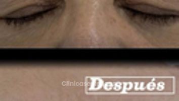 Blefaroplastia sin cirugia - Clínica Visage