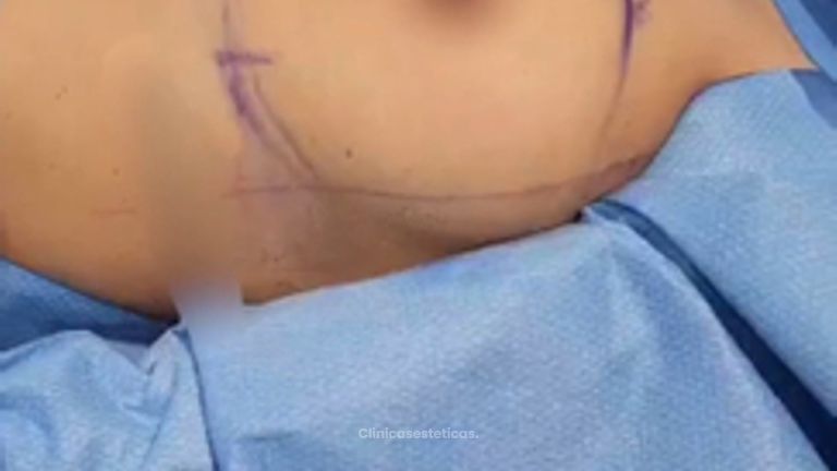 Aumento Mamario con implantes redondos - Dr. Nadir Carda