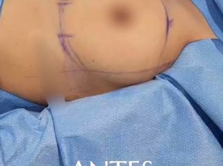 Aumento Mamario con implantes redondos - Dr. Nadir Carda