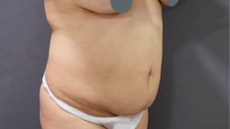 Abdominoplastia - Dr. Nadir Carda