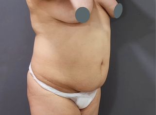Abdominoplastia - Dr. Nadir Carda
