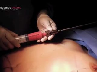 Convierte tu grasa en un pecho de mayor tamaño
