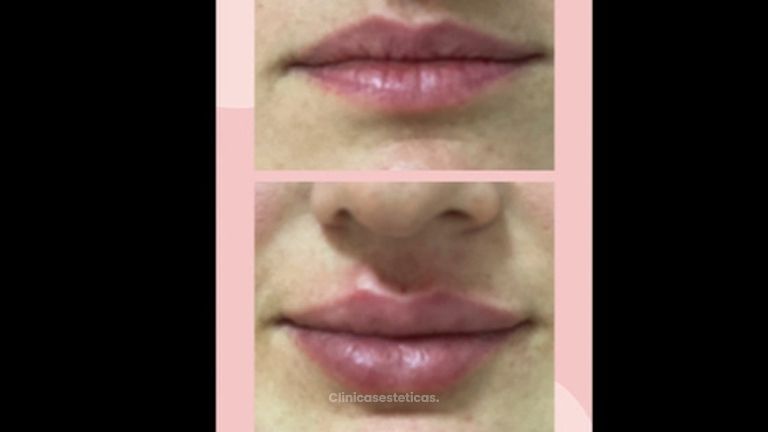 Antes y después Aumento de labios.