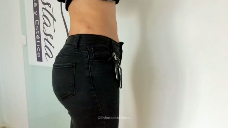 Abdominoplastia con transferencia de glúteos