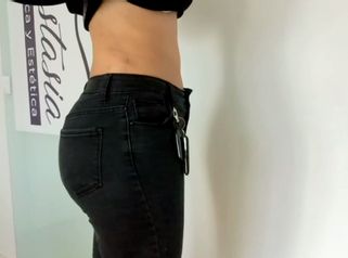 Abdominoplastia con transferencia de glúteos