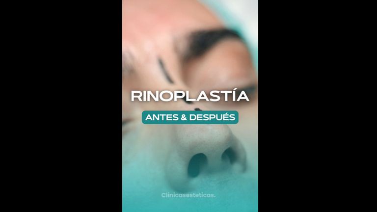 Rinoplastía - Dr. Pedro Vidal G-H