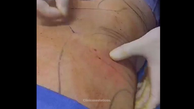 Liposucción - Medical Esthetic Co