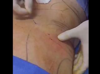 Liposucción - Medical Esthetic Co