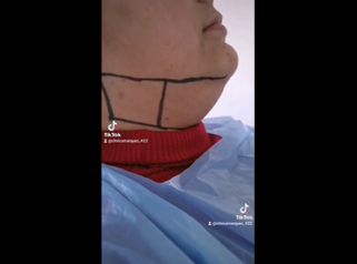 Liposucción de papada - Dra. Katherin Ruiz Márquez