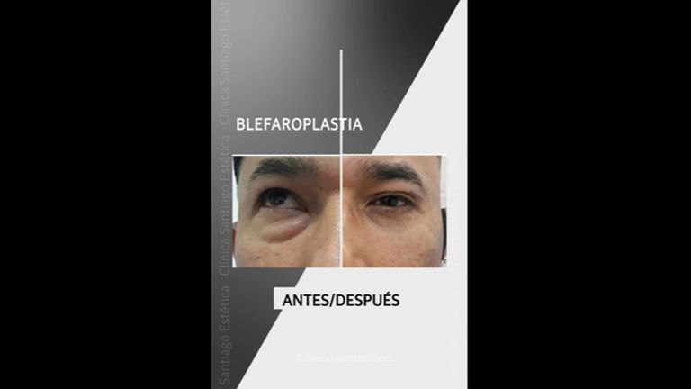 Blefaroplastia - Clínica Santiago Estética