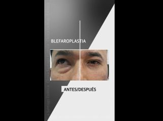 Blefaroplastia - Clínica Santiago Estética