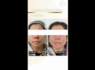 Restructuración facial - Dra. Katherin Ruiz Márquez