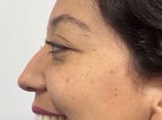 Rinoplastia - Dra. Angélica Sifontes Muñoz