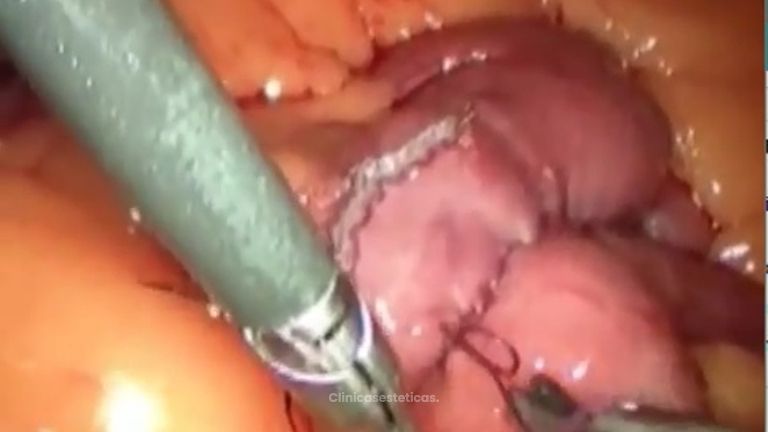 Bypass gastrico