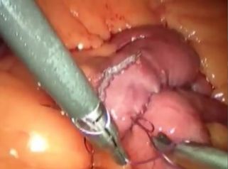Bypass gastrico