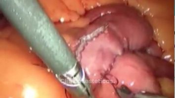 Bypass gastrico