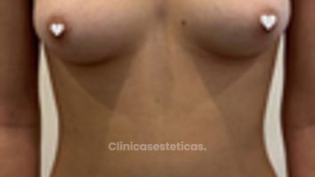 Aumento Mamario - Dr. Guillermo Santana