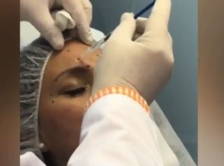Aplicación de toxina botulínica o Botox