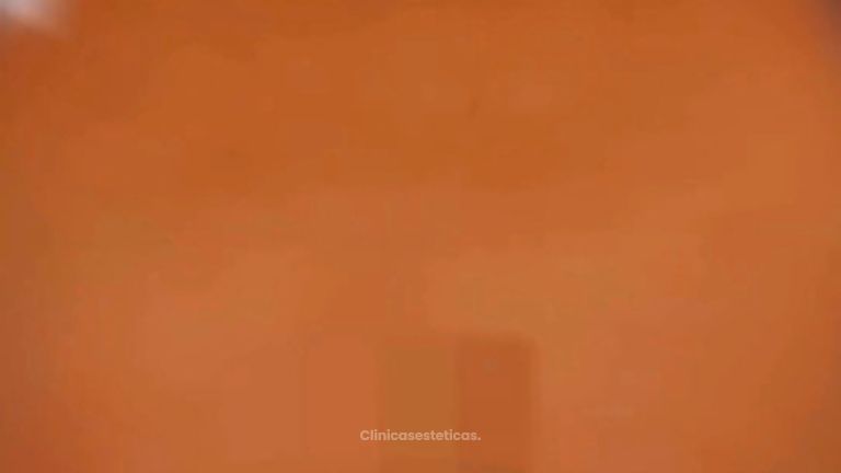 Liposucción - Dr. Matías Kufeke