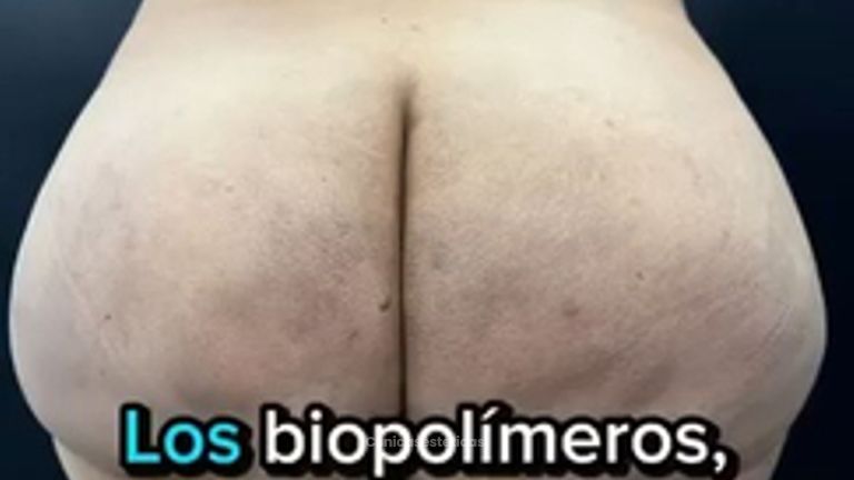 Retiro de Biopolímeros - Dr. Guillermo Santana