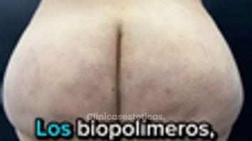 Retiro de Biopolímeros - Dr. Guillermo Santana