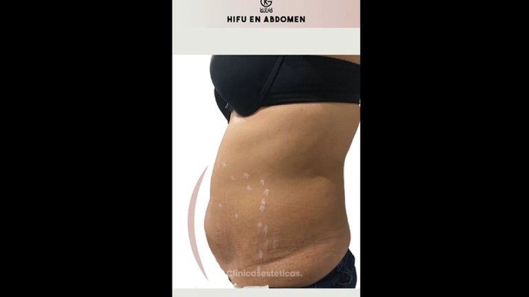 HIFU - Clínica Dra. Kelly Gulfo