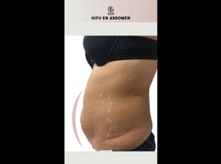 HIFU - Clínica Dra. Kelly Gulfo