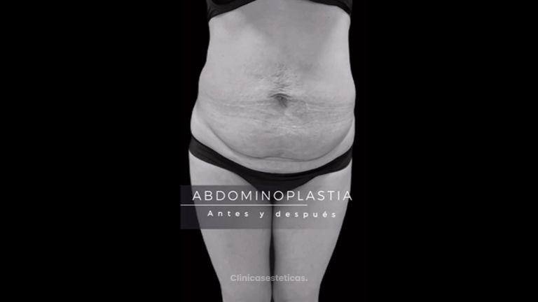 Abdominoplastia - Dr. Alvaro Rubio González
