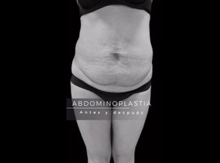 Abdominoplastia - Dr. Alvaro Rubio González