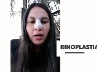 Testimonio rinoplastia - Cirugía Plástica Dieppa