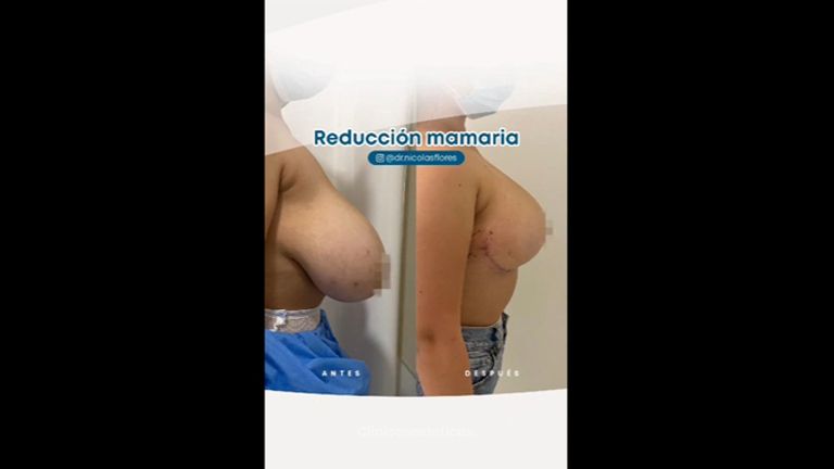 Reducción mamaria - Dr. Nicolás Flores Moltedo