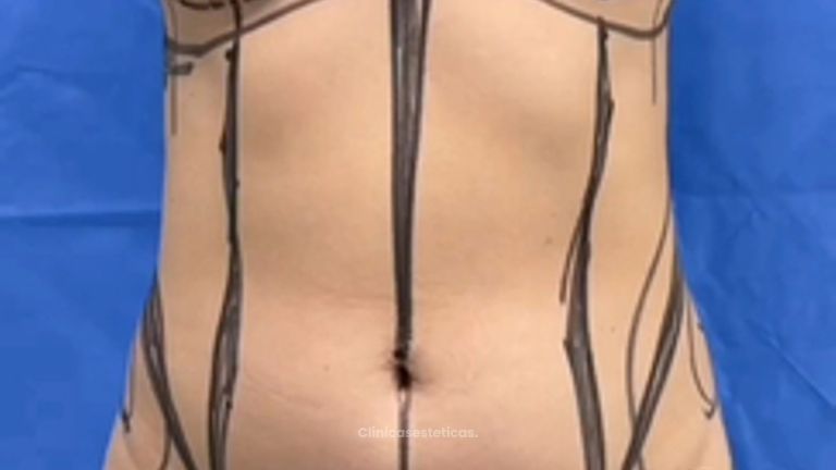 Cirugía Combinada Lipoescultura + Pexia con implantes - Cirugía Plástica Dieppa